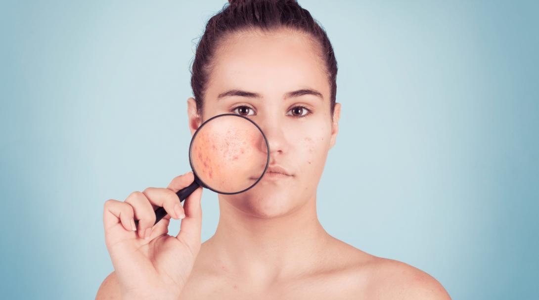 What is ‘Maskne’ and how to treat it?